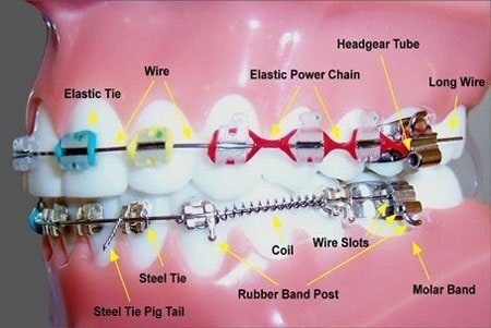what are braces?