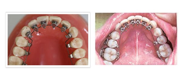 lingual braces