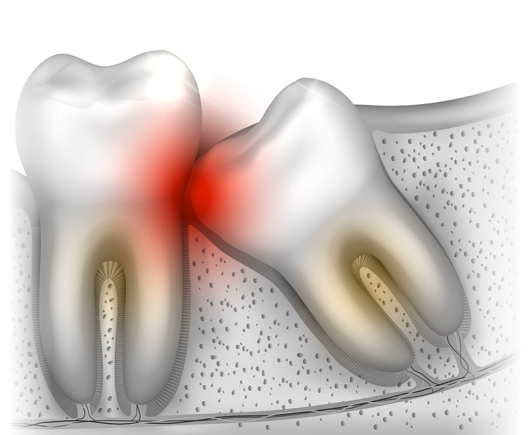 Pericoronitis: Causes, symptoms and treatment