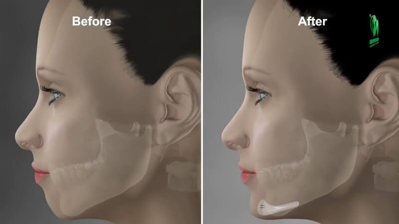 Is chin surgery dangerous?