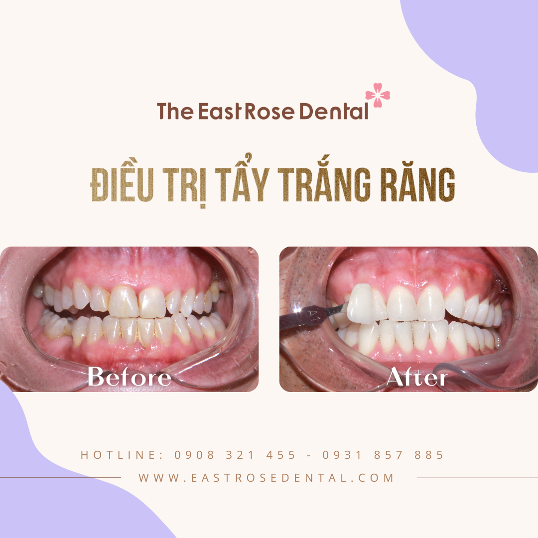 teeth whitening