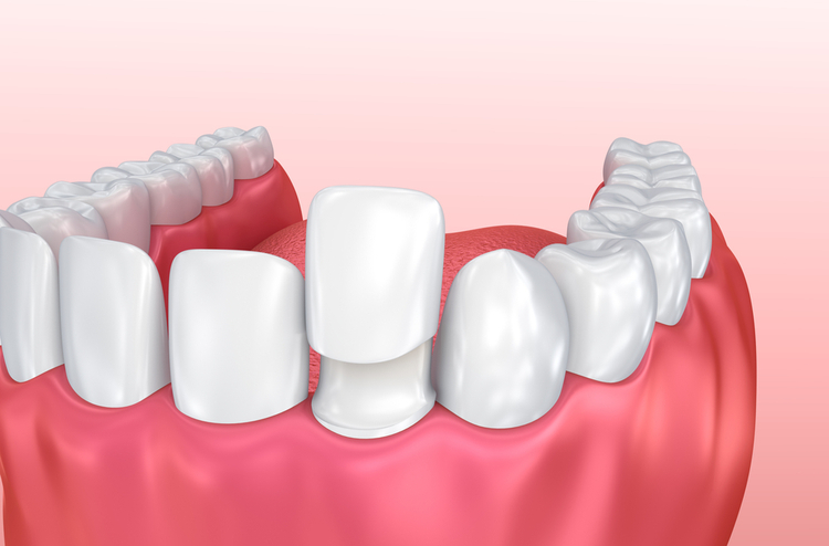 Porcelain veneer
