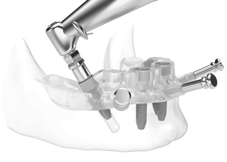 Implant All on 4 and All on 6