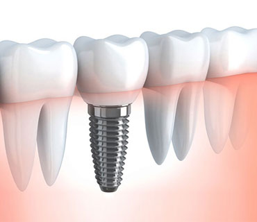 Implant