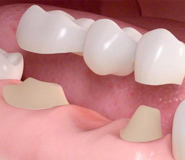 Porcelain crown and Porcelain bridge