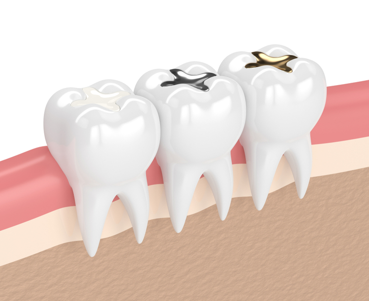 Teeth fillings