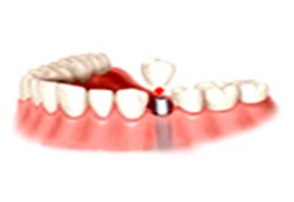1 implant, 1 abutment, 1 ceramic titanium crown