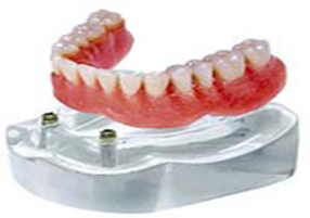 2 Implants, 2 balls/2 cocartors, an over denture (RP5)