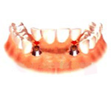 2 implants, 2 abutments, 4 unit ceramic titanium bridges
