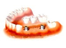 02 Implants, 02 Abuments, 03 unit Ceramic Titanium Bridges