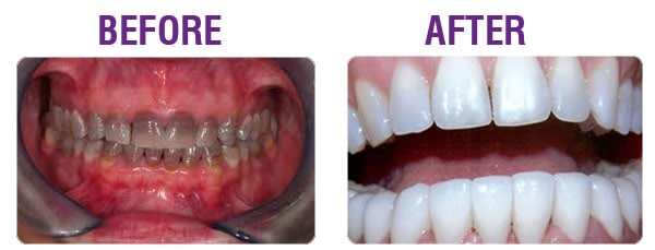 teeth-stained-3