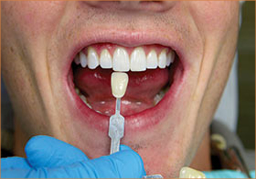 Create Whiter Smiles Faster