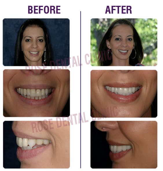 restore-your-smile-3