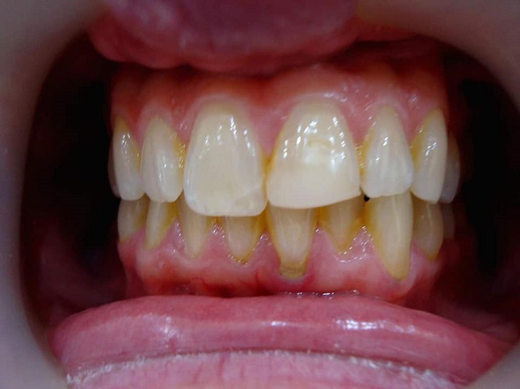 Veneer 2 before