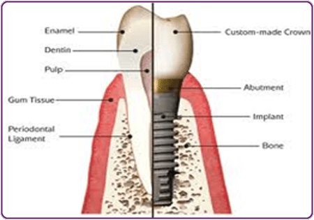 what is dental implant