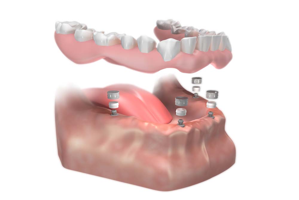 Will my all on 4 bridge look natural?
