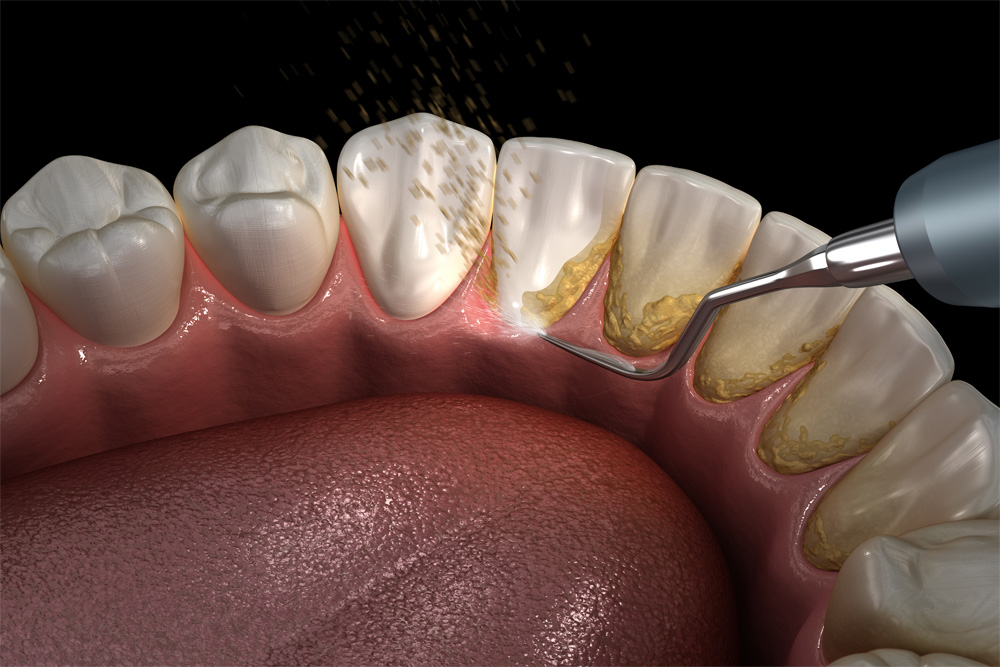 5 Important Symptoms of Gum Disease
