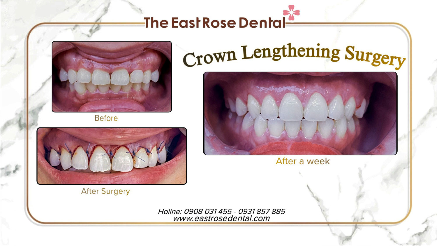 Crown Lengthening Surgery