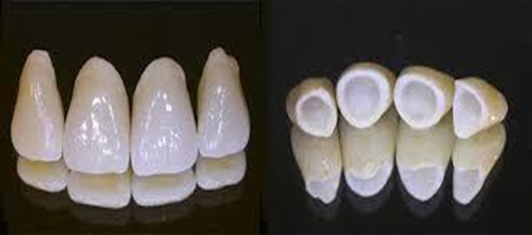 zicorina crowns