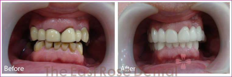 Benefits of All-Ceramic Zirconia Crowns