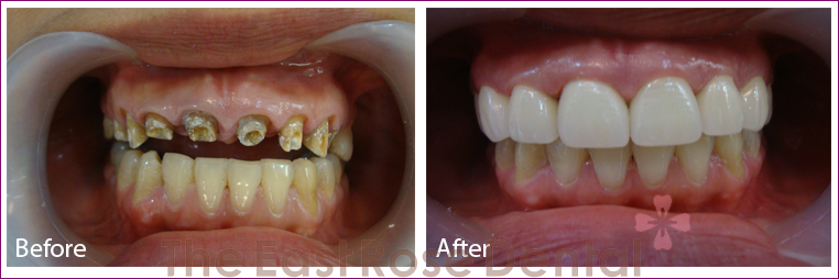 Benefits of All-Ceramic Zirconia Crowns