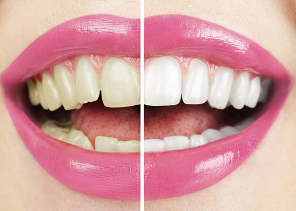 Hollywood smile - Cách bạn có được nụ cười rạng ngời tỏa nắng như cách ngôi sao Hollywood
