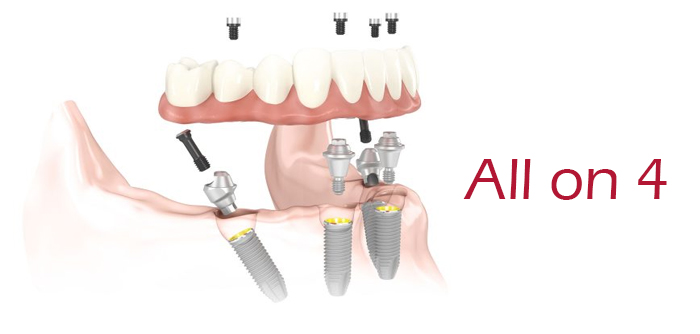 https://eastrosedental.com/en/dental-implant.html