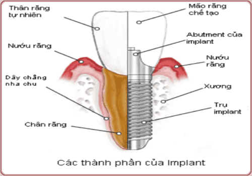 Thành phần răng implant