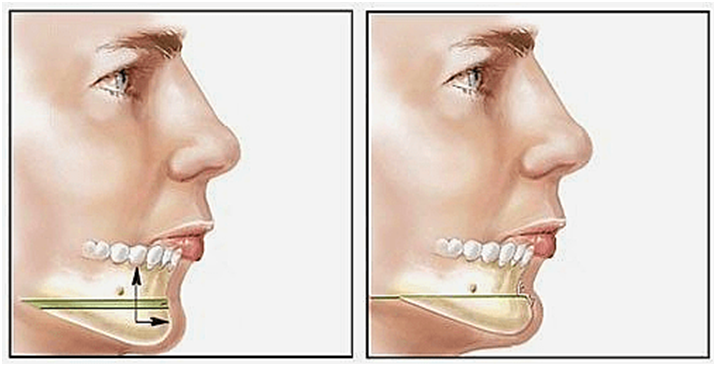 Where is the most prestigious address for receding chin surgery today?