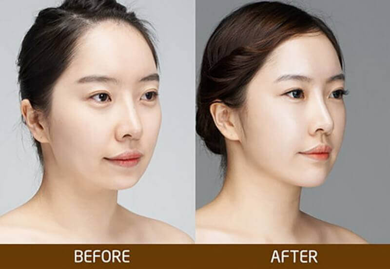 What is a receding chin? Anthropology of people with a low chin