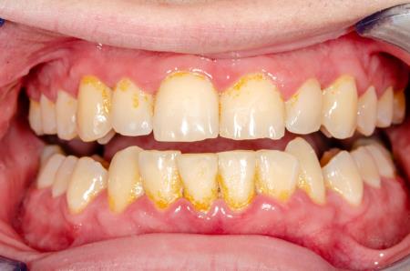 is tartar removal painful