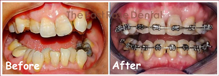 Braces & Invisalign 3