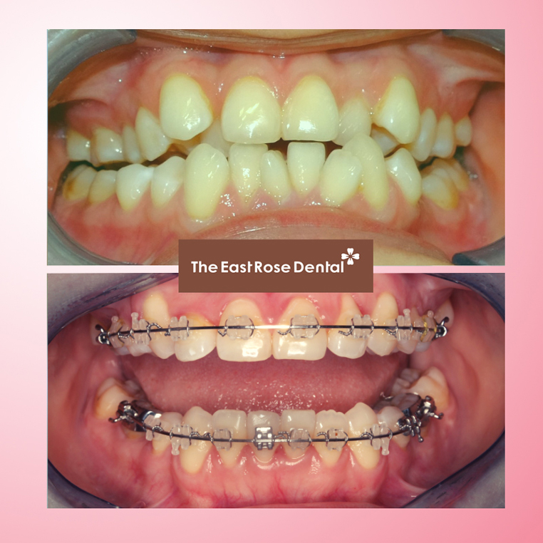 Braces & Invisalign 4