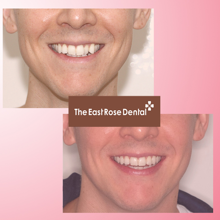 Braces & Invisalign 6