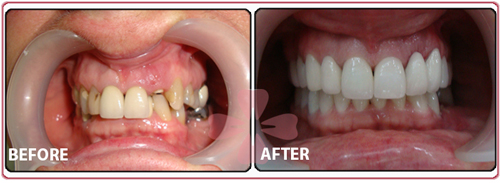 Implant + Ceramic Zirconia