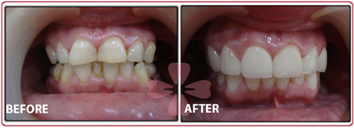 implant + Ceramic