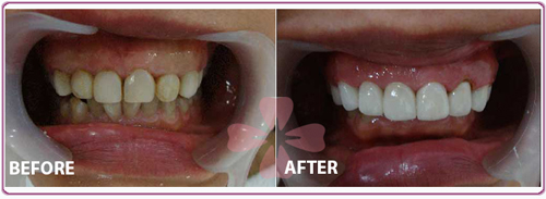 Whitening