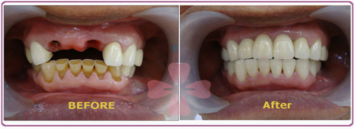 Implant - Zirconia