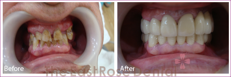 Implant 1