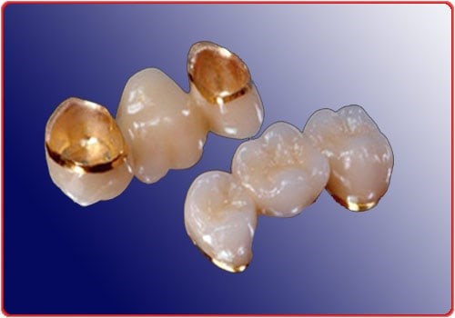 cầu răng sứ quý kim