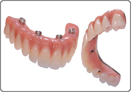 cầu răng toàn sứ Zirconia