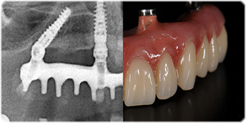 cầu răng titanium