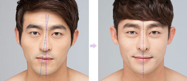 Correction of a lopsided chin - a method to help "recreate" facial contours