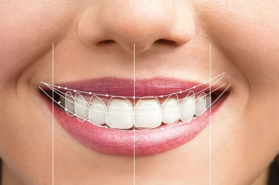  Tổng quan về điều trị cười hở lợi - Có ảnh hưởng đến sức khỏe không?