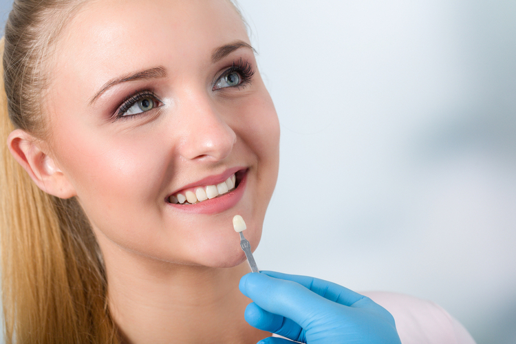 Everything you need to know about dental veneers 