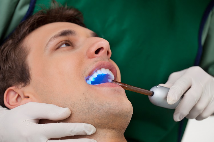 dental bonding procedure