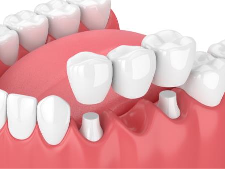 Dental bridges