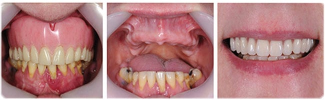 điều chỉnh nướu xương