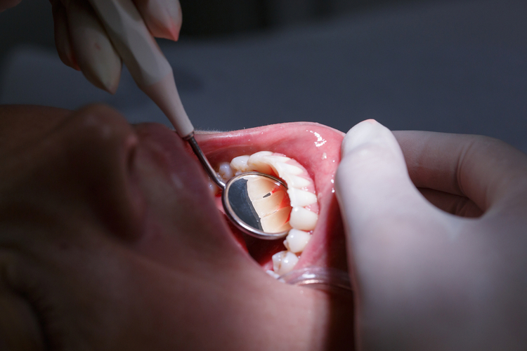 điều trị tụt lợi chân răng