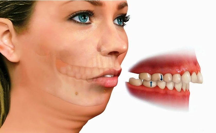 Jaw surgery and what you need to know